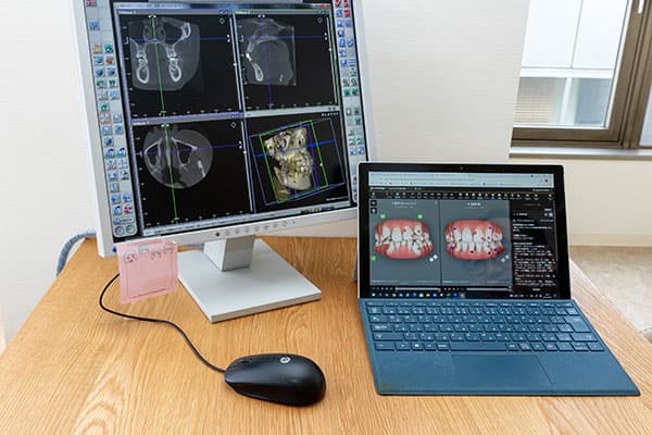 歯の移動シミュレーション作成